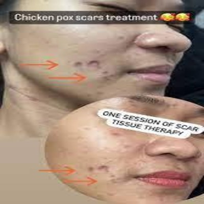 Electrocautery & Radiocautery