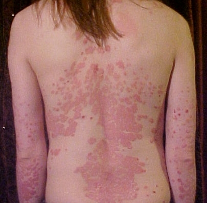 Best psoriasis Treatment in Delhi